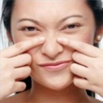 blackheads 1