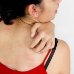 avoid tight fitting clothes in acne