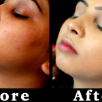 hide acne scars with concealer