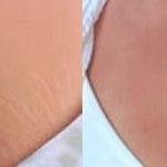 Microdermabrasion for breast stretch marks
