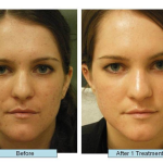 acne-scar-treatment-nyc