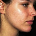 rosacea-cheeks-hd-young-looking-skin-find-out-the-best-way-to-get-beautiful-skin-image