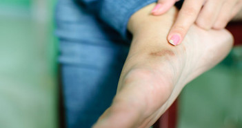 Corns-and-Callus