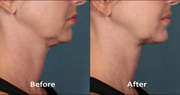 Get Rid Of Double Chin In Just 10 Minutes1