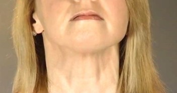 Get Rid Of Double Chin In Just 10 Minutes2