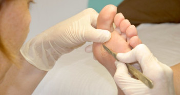 What-you-can-do-to-cure-Corn-or-Callus