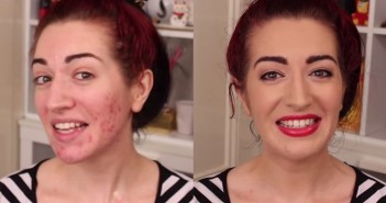 use foundation on acne face’
