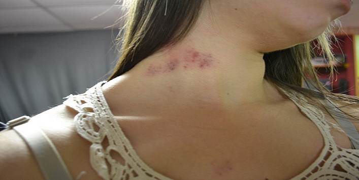 Love Bites and Hickeys5.