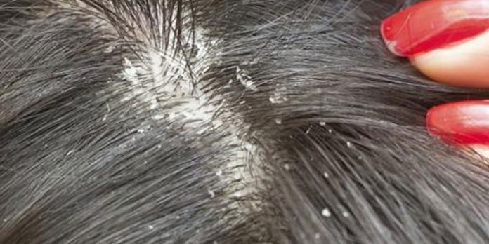 4 Different Types of Dandruff & How to Tackle Them Effectively