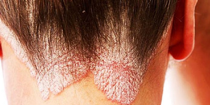 4 Types Of Dandruff And How To Treat Them